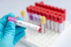 Dovere d’informativa del medico: l’obbligo di denuncia all’autorità sanitaria delle diagnosi di Hiv e Aids